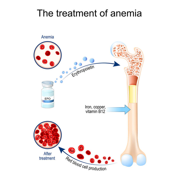 Erythropoietin and treatment of anemia. Glycoprotein cytokine that stimulates red blood cell production. erythropoiesis. Vial with EPO. anemia before and after therapy. Vector illustration - Vector, Imagen