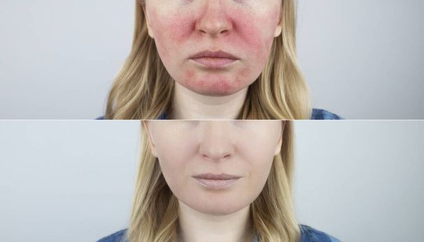 Rosacea face. The girl suffers from redness on her cheeks. Couperosis of the skin. Redness and capillary mesh are visible on the face. Treatment and removal. Vascular surgery and dermatology - Foto, Imagem