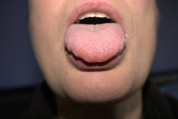 geschwollene, vergrößerte, weiße Zunge mit welligen, wellenförmigen überbuchten Rändern (medizinischer Name ist Makroglossie) und Unebenheiten - Foto, Bild