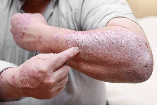 乾癬の皮膚の急性形態.亀裂、ハード、角質、ちらつきのある皮膚を持つ腕を示す男性。アレルギーの皮膚科の問題,湿疹.手の汚れ、発疹、乾燥肌。慢性疾患治療の概念. - 写真・画像