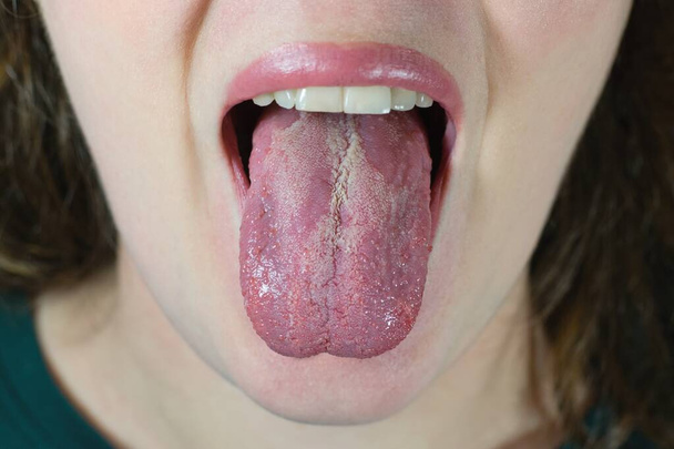 Oral Candidiasis or Oral trush (Candida albicans), yeast infection on the human tongue, common side effect when using antibiotics or another medicaments. Young woman with low immunity. - Photo, image