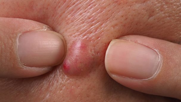 Bacterial skin infection. Big Acne Cyst Abscess or Ulcer Swollen area within face skin tissue. Containing accumulation of pus and blood. Macro shot of Acne or Dermatitis near mouth on face. Skincare. - Foto, imagen
