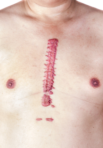The hypertrophic scar or swell cicatrix is big and long, convex and large. On the chest, the skin is pink and red. Occurs after surgery. Aortic dissection type A by opening the chest. - Photo, Image