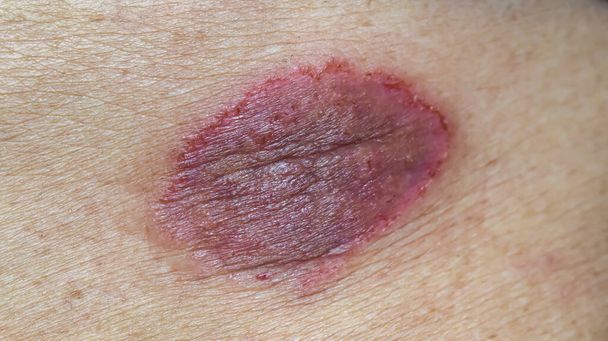 Tinea corporis or ringworm. Itching skin lesions on the abdomen of Asian elderly woman.  - Fotoğraf, Görsel