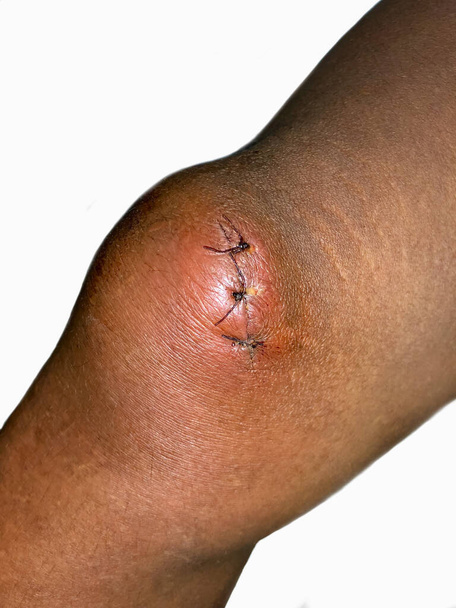 Stitched wound in the knee of Southeast Asian child. - Fotó, kép