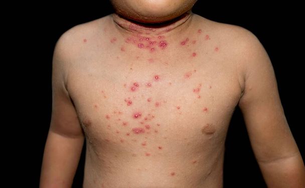Molluscum contagiosum skin lesions also called water warts of Asian child. - Foto, imagen