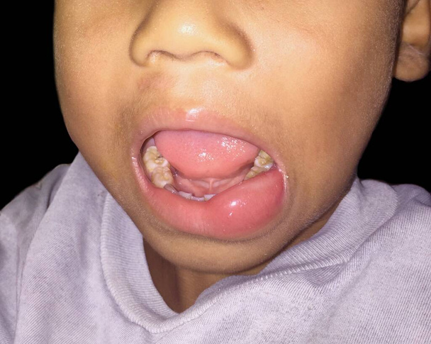 Angioedema біля нижньої губи азіатської чоловічої дитини. Причиною цього є ліки, морепродукти, хімічна алергія та укус комах.. - Фото, зображення