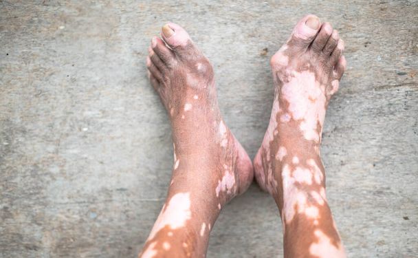 The old man's leg with a skin condition that causes loss of melanin posing indoors. The foot model in a black tank top suffers from vitiligo disorder. - Zdjęcie, obraz