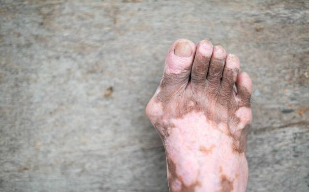 The old man's leg with a skin condition that causes loss of melanin posing indoors. The foot model in a black tank top suffers from vitiligo disorder. - Fotoğraf, Görsel