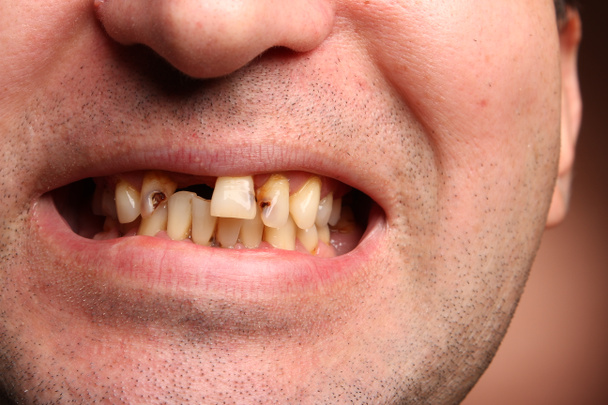 Denti cattivi fumatore
 - Foto, immagini
