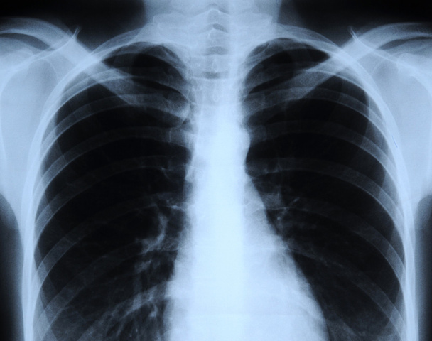 emberi chest röntgenfelvétel - Fotó, kép