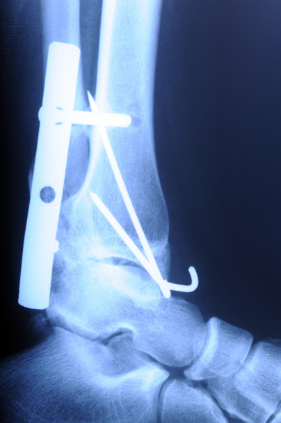 рентген перелома лодыжки человека
 - Фото, изображение