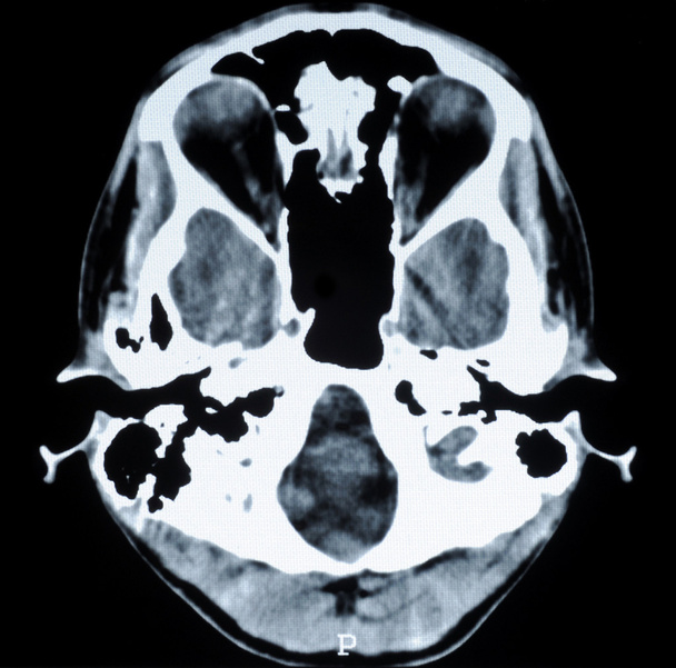 КТ-фото человеческого мозга
 - Фото, изображение