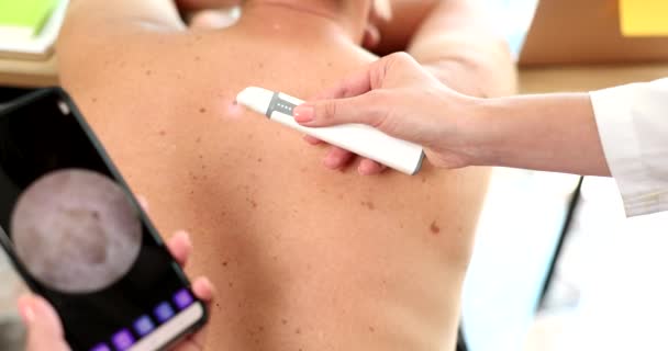Doctor examining patient pigmented nevi using dermatoscope with mobile phone closeup 4k movie slow motion. Diagnosis and treatment of melanoma dermatoscopy concept  - Footage, Video