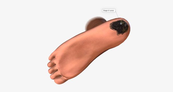 Acral Lentiginous Melanoma (ALM) on The Body 3D rendering - Fotoğraf, Görsel
