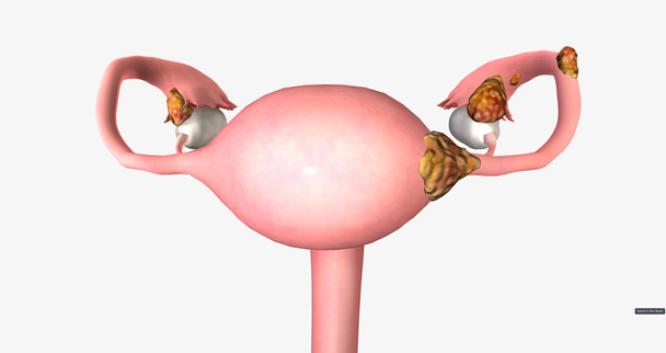 Stage II ovarian tumor has spread to nearby organs, such as the uterus and the body of the fallopian tubes. 3D rendering - Foto, imagen
