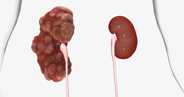 Polycystic kidney disease (PKD) is an inherited disorder of the kidneys. 3D rendering - Φωτογραφία, εικόνα