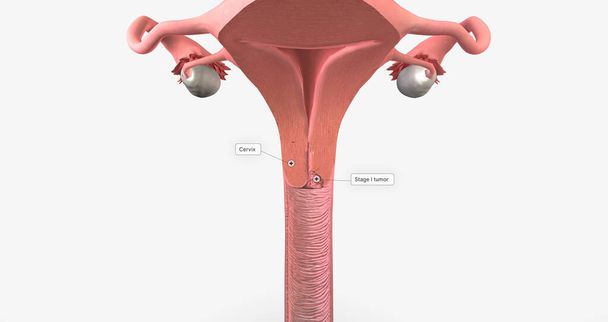 In stage I, the cancer is very small and confined to the cervix 3D rendering - Foto, immagini