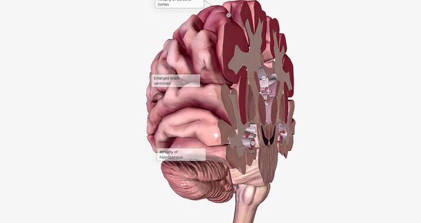 Alzheimer's Disease Brain Cross Section 3D rendering - Foto, Imagem