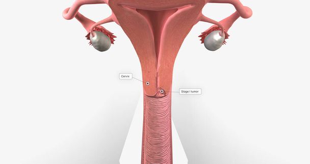 In stage I, the cancer is very small and confined to the cervix 3D rendering - Foto, afbeelding