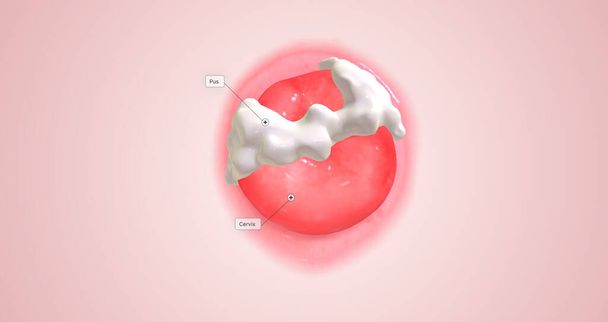 In women, chlamydia bacteria infect the cervix, causing cervical inflammation, pus production, and discharge.3D rendering - Фото, изображение