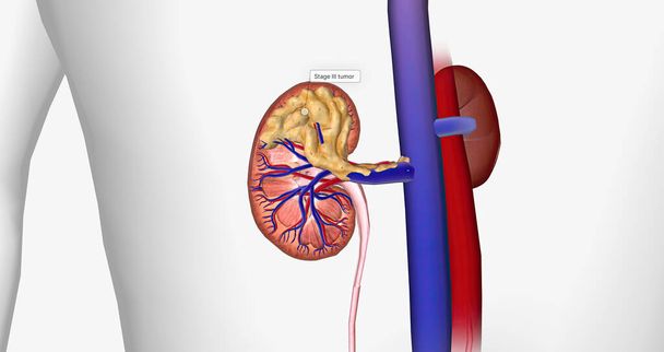 The Kidney Cancer, Stage III 3D rendering - Φωτογραφία, εικόνα