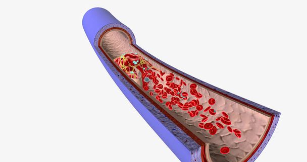 A blood clot in a vein, or venous thrombus, is the clumping of blood in vessels that bring blood back to the heart. 3D rendering - Fotó, kép