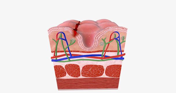 Anal fissure is a small tear in the lining of the anal mucosa. 3D rendering - Foto, afbeelding
