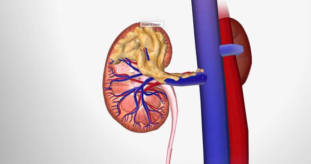 The Kidney Cancer, Stage III 3D rendering - Zdjęcie, obraz