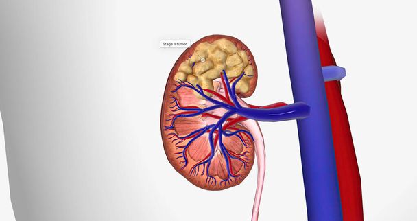 The Kidney Cancer, Stage II 3D rendering - Zdjęcie, obraz