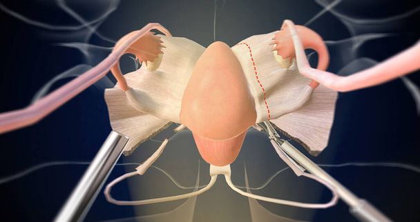 Відсікання та лігування фаллопієвих трубок та яєчників 3D рендерингу
 - Фото, зображення