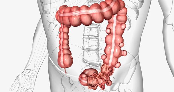 Diverticulosis is a condition characterized by the formation of diverticula in the walls of the intestines. 3D rendering - Фото, изображение