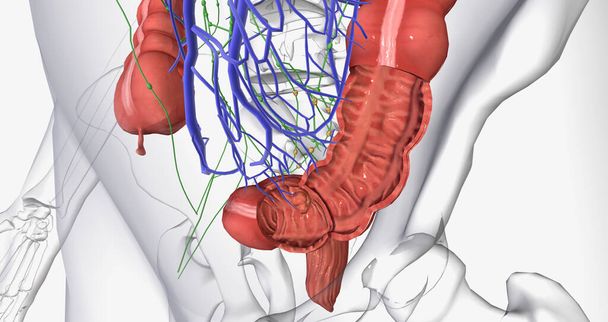 Colorectal cancer (CRC) is a common colon or rectal cancer that affects many patients over middle age. 3D rendering - Zdjęcie, obraz