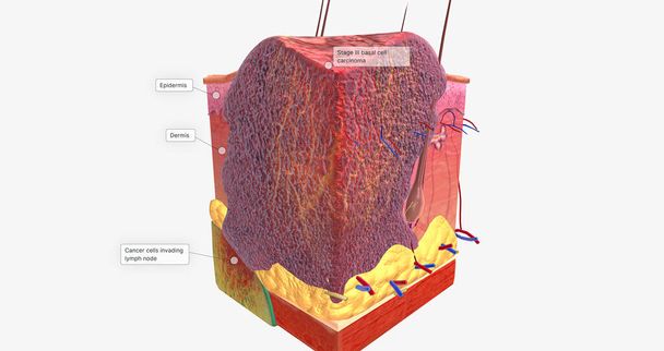 Basal Cell Carcinoma in Tissue, Stage III 3D rendering - Φωτογραφία, εικόνα