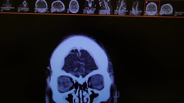 CT Brain angiography - coronal image - black, white - Metraje, vídeo