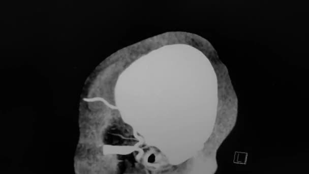 CT Brain angiography - sagittal image - black, white - Metraje, vídeo