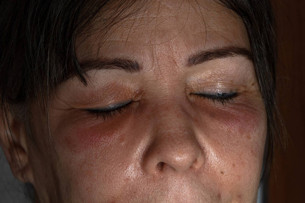 lähikuva naisesta, jolla on turvonneet ja mustelmat silmissä. Naisiin kohdistuvaa väkivaltaa koskeva aihe - Valokuva, kuva