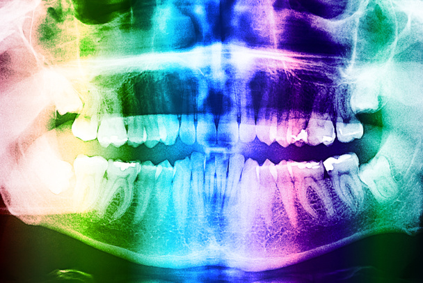 Radiografia dentale dei denti
 - Foto, immagini