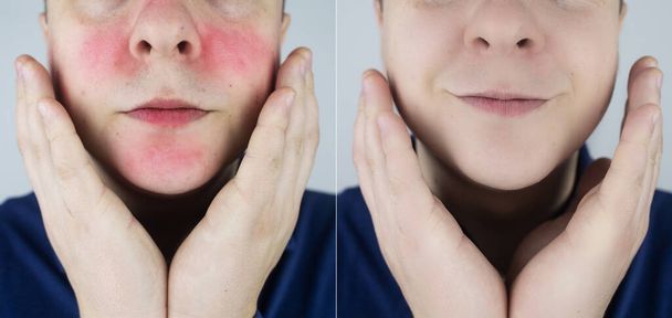 Rosacea face. The man suffers from redness on her cheeks. Couperose of the skin. Redness and capillary mesh are visible on the face. Treatment and removal. Vascular surgery and dermatology - Foto, afbeelding