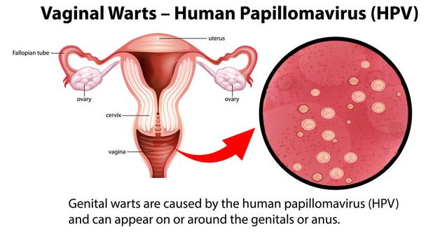 Vaginal Warts - Human Papillomavirus (HPV) infographic with explanation illustration - Vector, afbeelding