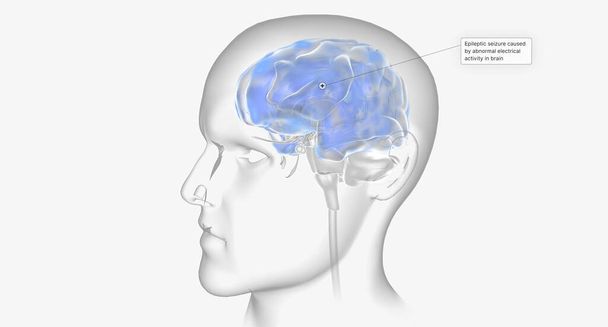 Эпилептический припадок, вызванный аномальной электрической активностью в 3D рендеринге мозга - Фото, изображение