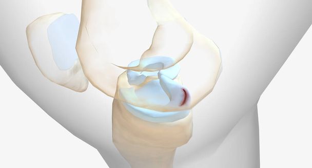 A meniscus tear is one of the most common knee injuries.3D rendering - Foto, immagini