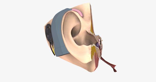 Un implante coclear es un dispositivo electrónico pequeño y complejo que puede ayudar a proporcionar una sensación de sonido. Renderizado 3D - Foto, imagen
