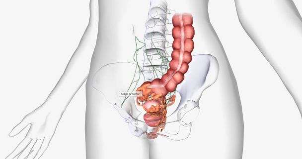 Stage IV cancer is characterized by the distant spread of the tumor outside the uterus. 3D rendering - Fotografie, Obrázek