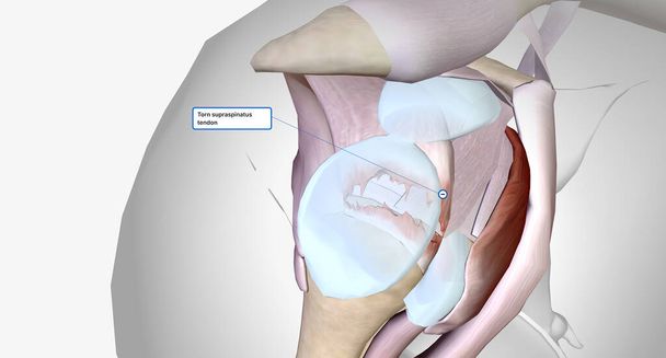 Torn rotator cuff is a musculoskeletal injury that results from damage to the rotator cuff muscles or tendons.3D rendering - Foto, Bild