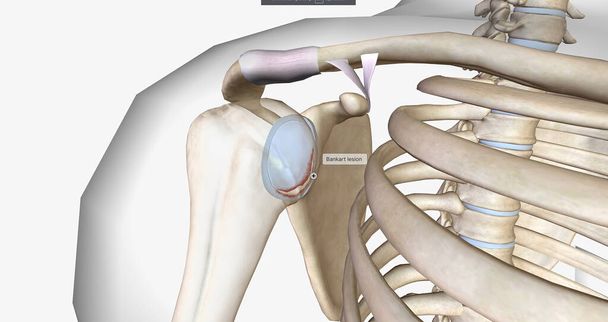 Пошкодження Банкарта виникає внаслідок переднього вивиху плеча.3D рендеринга
 - Фото, зображення