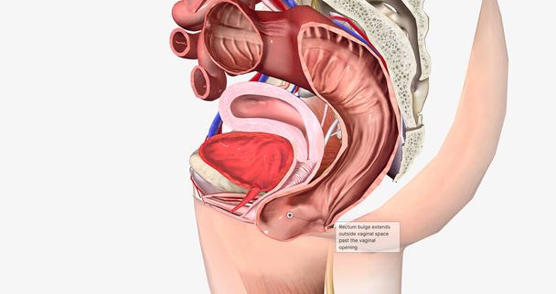 Rectum bulge extends outside vaginal space past the vaginal opening 3D rendering - 写真・画像