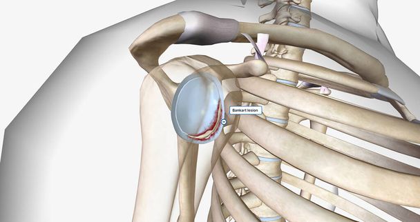 Пошкодження Банкарта виникає внаслідок переднього вивиху плеча.3D рендеринга
 - Фото, зображення