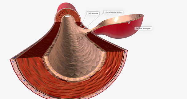 Η πλειοψηφία των ανευρυσμάτων του εγκεφάλου είναι ακαριαία ανευρύσματα που είναι στρογγυλά και επεκτείνονται από τη μία πλευρά του αγγείου. 3D απόδοση - Φωτογραφία, εικόνα