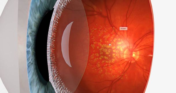 Dry macular degeneration is a type of age-related vision impairment that results in blurred or lost central vision.3D rendering - 写真・画像